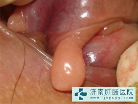 肠息肉图片