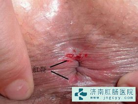 肛裂图片