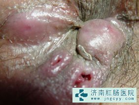 肛瘘图片