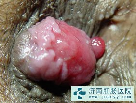 混合痔图片