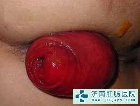 脱肛图片