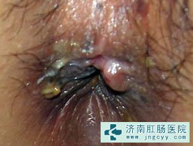 外痔图片