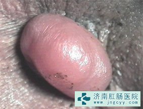 炎性外痔