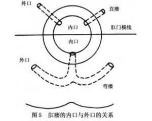 肛瘘怎么回事？如何治疗？