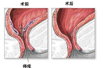 长痔疮会自然好吗