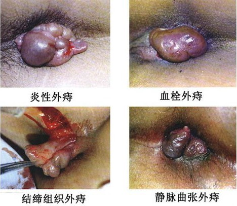 痔疮的图片_济南肛肠医院