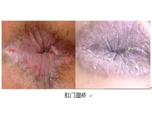 肛门湿疹症状图片