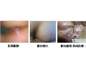 肛瘘的图片