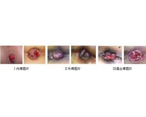 图文并茂详解女性痔疮的症状图片
