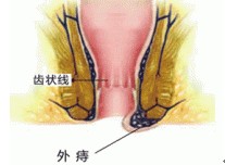 得了外痔怎么办？