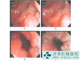 得了肠炎，怎么办？