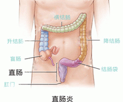 直肠炎有什么症状?如何治疗?