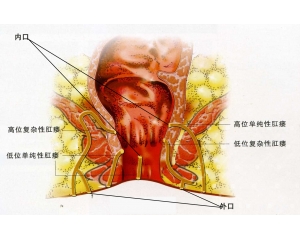 专家解读：肛瘘的症状及治疗